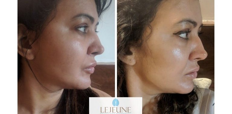 Skin Boosters – The latest trend in Indian Aesthetic Market