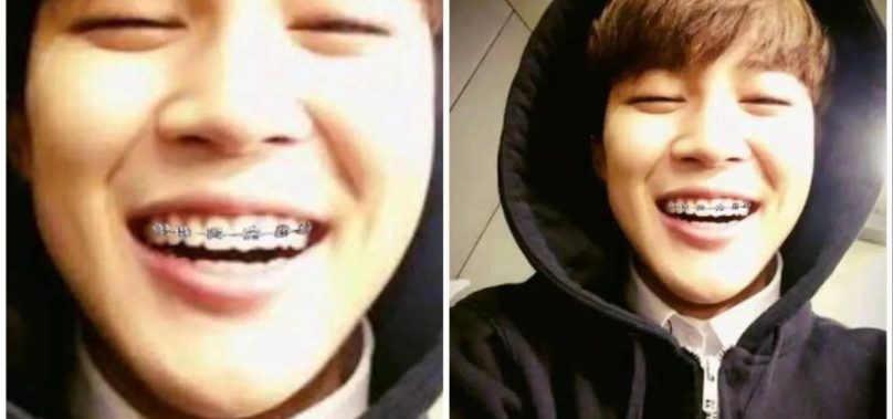 Why did BTS’s Jimin consider embracing braces?