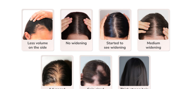 Traya’s Study Reveals a Concerning Finding: One in Two Women Aged 36-40 Suffer from Advanced Widening or Female Pattern Hair Loss