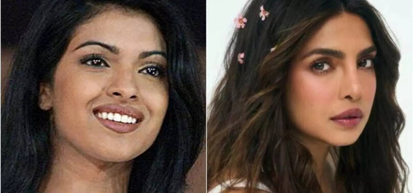 Surgery gone wrong: Priyanka’s honest confession